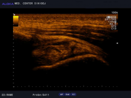 Ultrazvok rame - natrganje tetive supraspinatusa